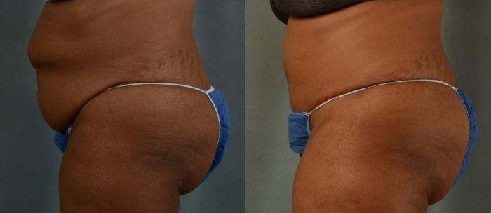 Before & After Tummy Tuck (Abdominoplasty) Case 436 View #2 View in Tallahassee, FL