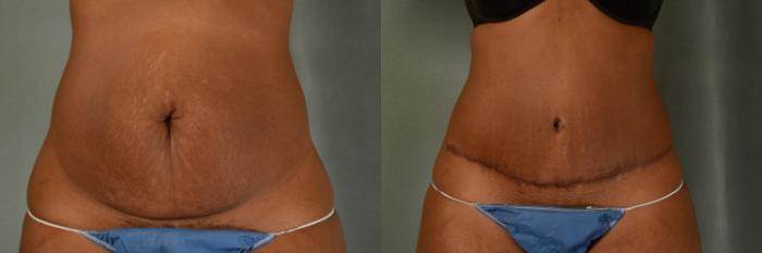 Before & After Tummy Tuck (Abdominoplasty) Case 438 Front View in Tallahassee, FL