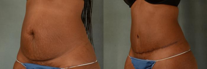 Before & After Tummy Tuck (Abdominoplasty) Case 438 Left Oblique View in Tallahassee, FL