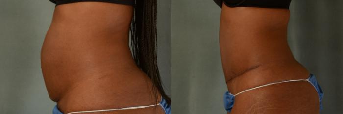 Before & After Tummy Tuck (Abdominoplasty) Case 438 Left Side View in Tallahassee, FL