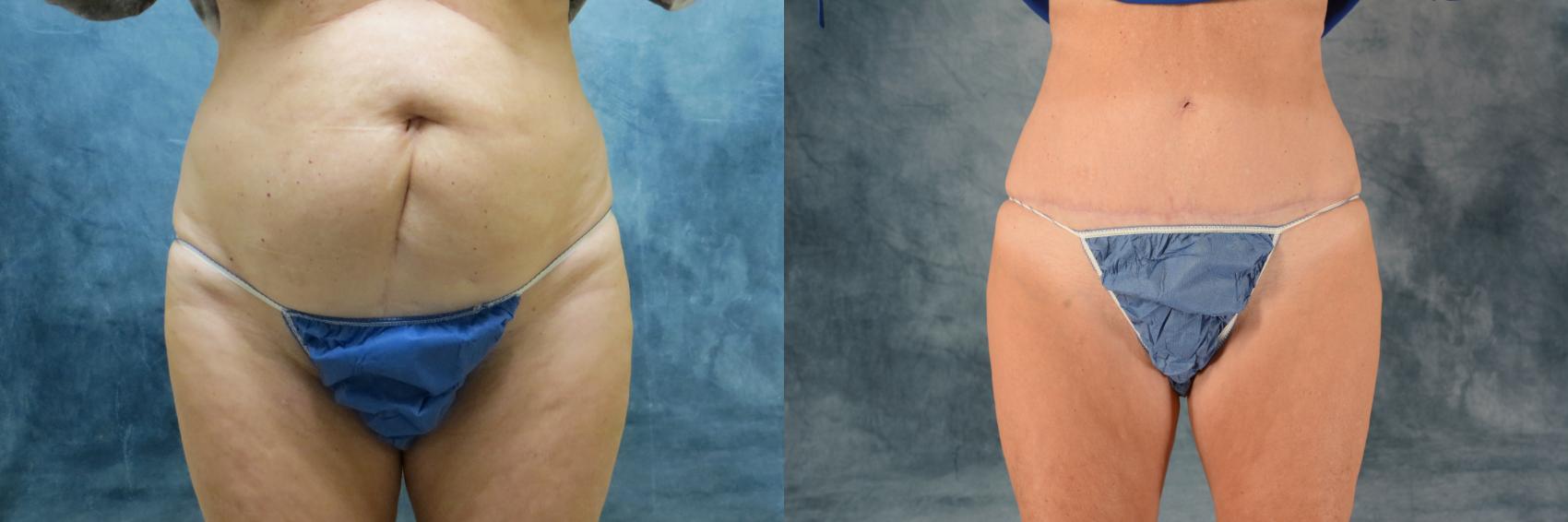 Before & After Tummy Tuck (Abdominoplasty) Case 493 Front View in Tallahassee, FL