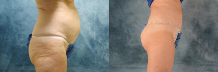 Before & After Tummy Tuck (Abdominoplasty) Case 493 Right Side View in Tallahassee, FL