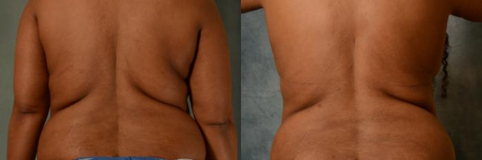 Before & After Tummy Tuck (Abdominoplasty) Case 515 Back View in Tallahassee, FL