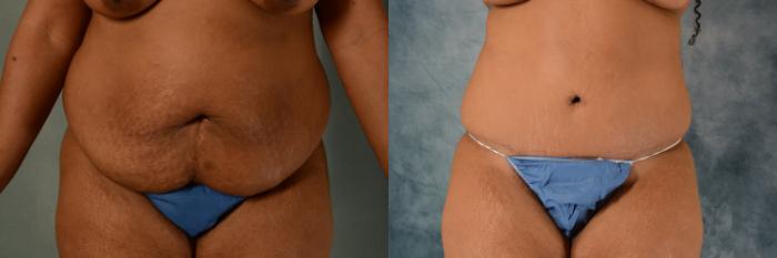 Before & After Tummy Tuck (Abdominoplasty) Case 515 Front View in Tallahassee, FL