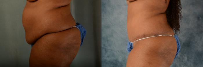 Before & After Tummy Tuck (Abdominoplasty) Case 515 Left Side View in Tallahassee, FL