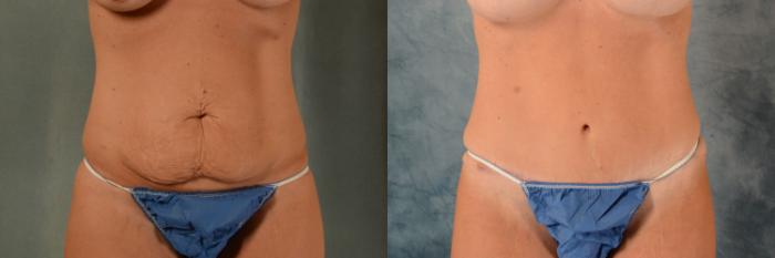 Before & After Tummy Tuck (Abdominoplasty) Case 528 Front View in Tallahassee, FL