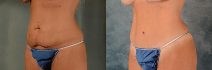 Before & After Tummy Tuck (Abdominoplasty) Case 528 Left Oblique View in Tallahassee, FL