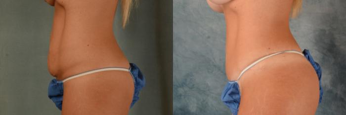Before & After Tummy Tuck (Abdominoplasty) Case 528 Left Side View in Tallahassee, FL