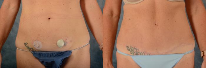 Before & After Tummy Tuck (Abdominoplasty) Case 529 Front View in Tallahassee, FL