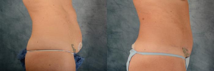 Before & After Tummy Tuck (Abdominoplasty) Case 529 Right Side View in Tallahassee, FL