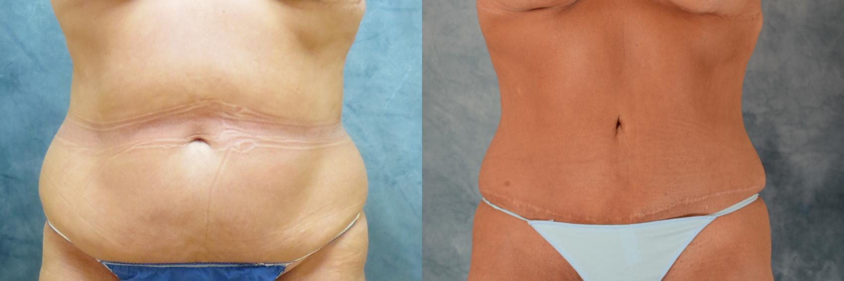 Before & After Tummy Tuck (Abdominoplasty) Case 534 Front View in Tallahassee, FL