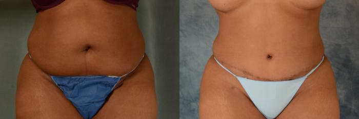 Before & After Tummy Tuck (Abdominoplasty) Case 538 Front View in Tallahassee, FL
