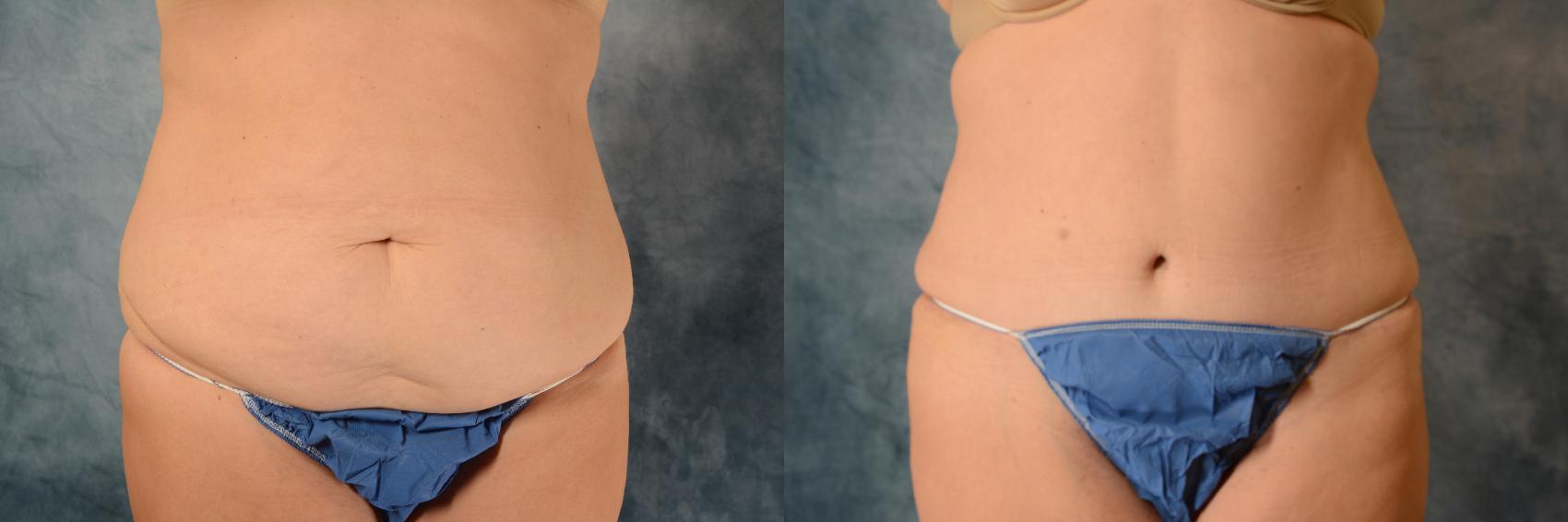 Before & After Tummy Tuck (Abdominoplasty) Case 541 Front View in Tallahassee, FL