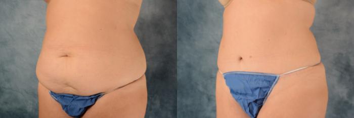 Before & After Tummy Tuck (Abdominoplasty) Case 541 Left Oblique View in Tallahassee, FL