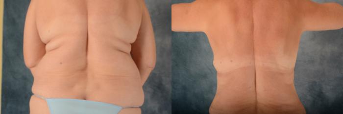 Before & After Tummy Tuck (Abdominoplasty) Case 543 Back View in Tallahassee, FL