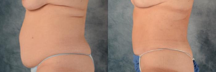 Before & After Tummy Tuck (Abdominoplasty) Case 543 Left Side View in Tallahassee, FL
