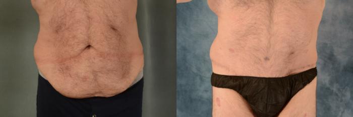 Before & After Tummy Tuck (Abdominoplasty) Case 552 Front View in Tallahassee, FL