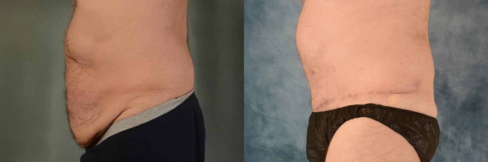 Before & After Tummy Tuck (Abdominoplasty) Case 552 Left Side View in Tallahassee, FL