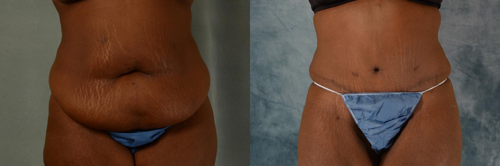Before & After Tummy Tuck (Abdominoplasty) Case 568 Front View in Tallahassee, FL