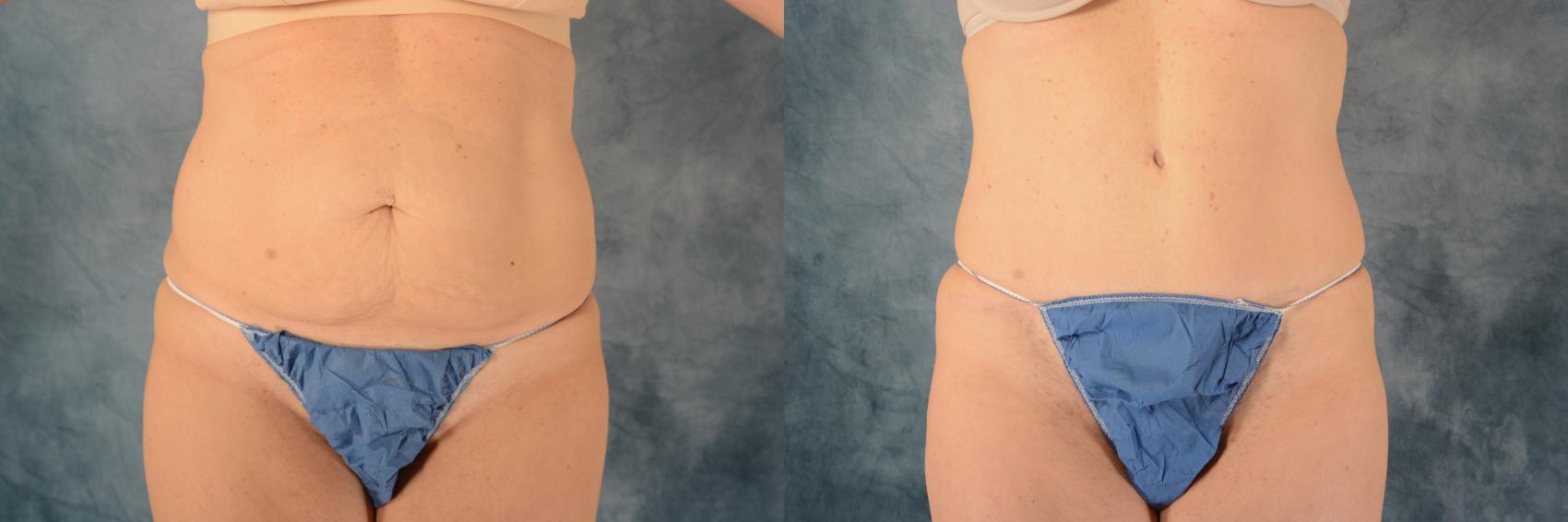 Before & After Tummy Tuck (Abdominoplasty) Case 572 Front View in Tallahassee, FL