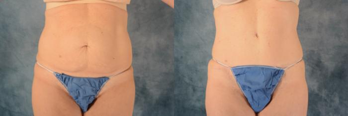 Before & After Tummy Tuck (Abdominoplasty) Case 572 Front View in Tallahassee, FL