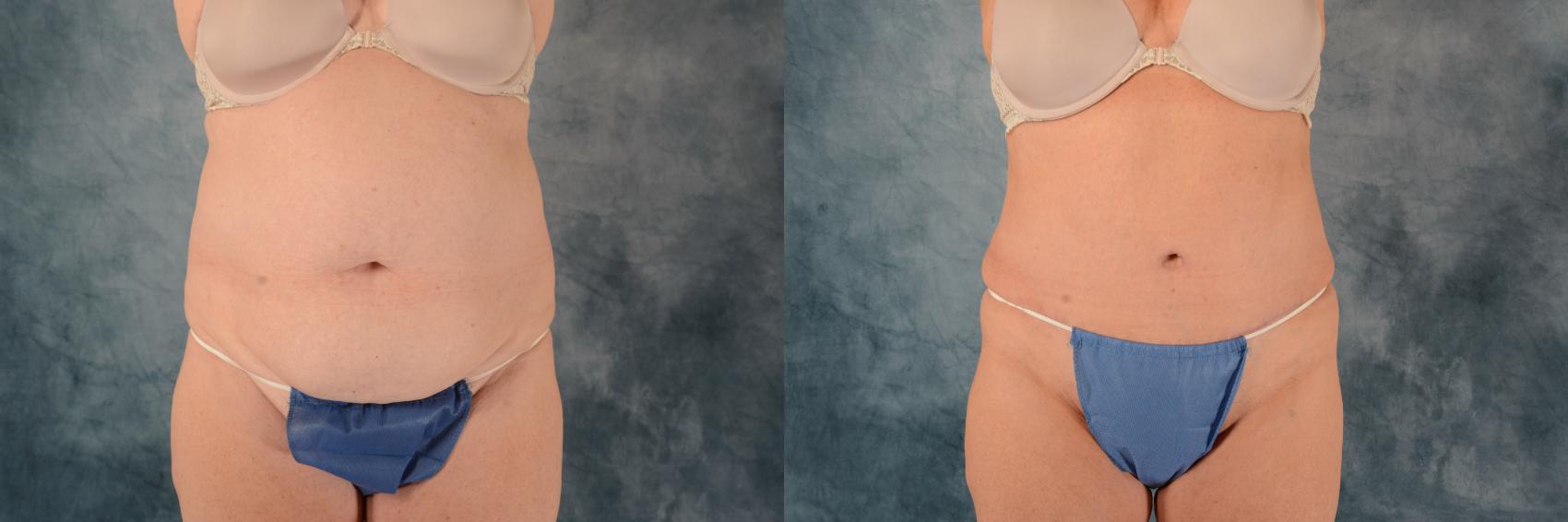 Before & After Tummy Tuck (Abdominoplasty) Case 575 Front View in Tallahassee, FL