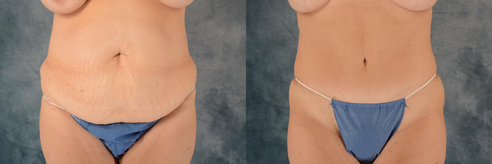 Before & After Tummy Tuck (Abdominoplasty) Case 581 Front View in Tallahassee, FL