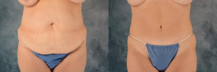 Before & After Tummy Tuck (Abdominoplasty) Case 581 Front View in Tallahassee, FL