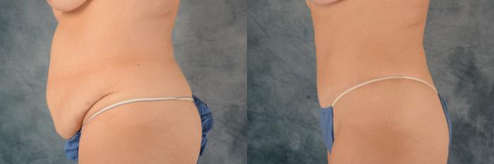 Before & After Tummy Tuck (Abdominoplasty) Case 581 Left Side View in Tallahassee, FL