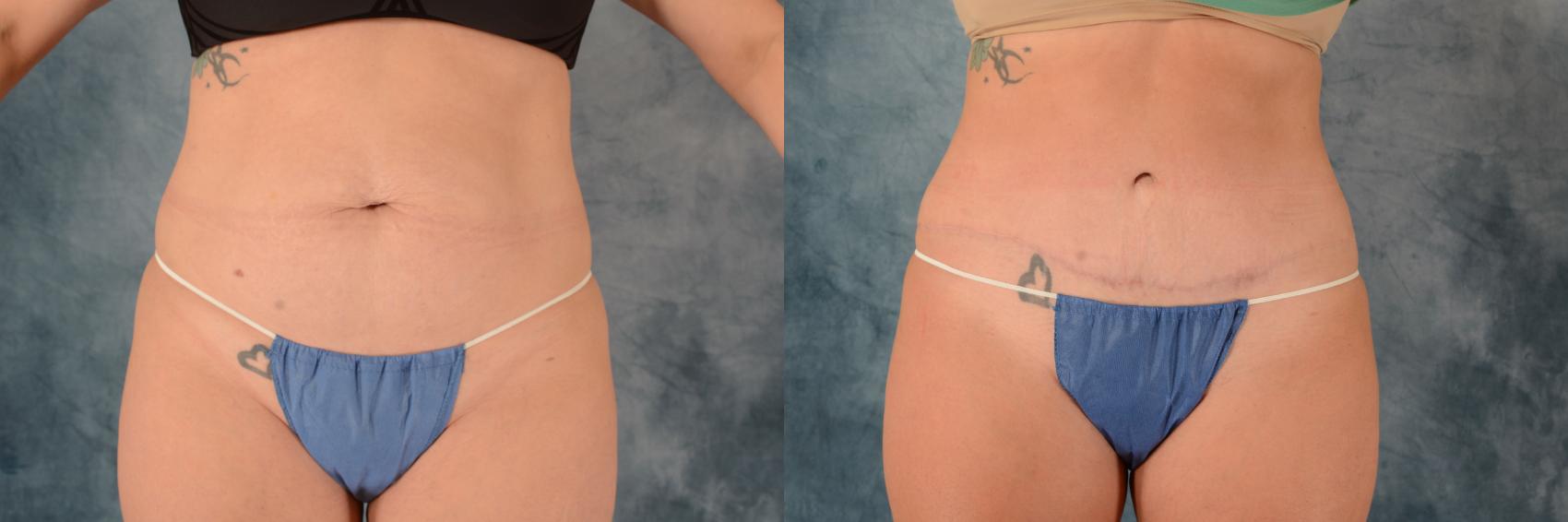 Before & After Tummy Tuck (Abdominoplasty) Case 600 Front View in Tallahassee, FL