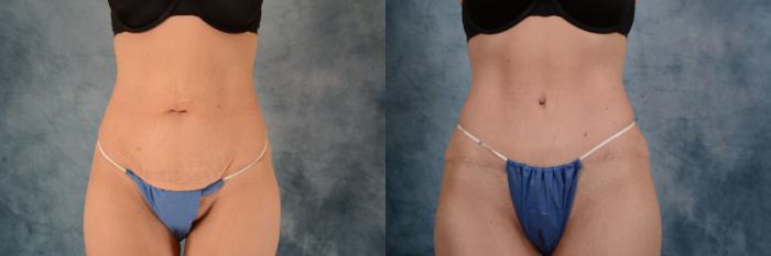 Before & After Tummy Tuck (Abdominoplasty) Case 614 Front View in Tallahassee, FL