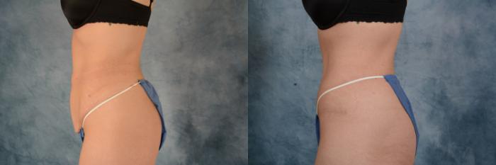 Before & After Tummy Tuck (Abdominoplasty) Case 614 Left Side View in Tallahassee, FL