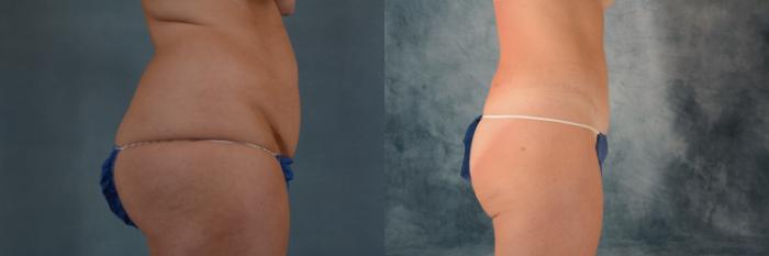 Before & After Tummy Tuck (Abdominoplasty) Case 628 Right Side View in Tallahassee, FL