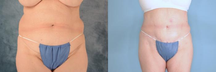 Before & After Tummy Tuck (Abdominoplasty) Case 652 Front View in Tallahassee, FL