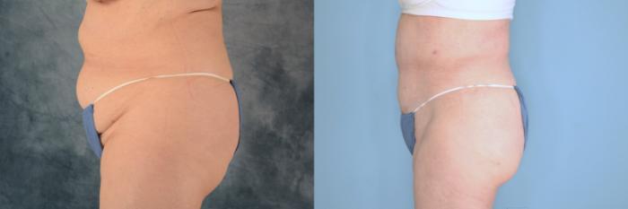 Before & After Tummy Tuck (Abdominoplasty) Case 652 Left Side View in Tallahassee, FL