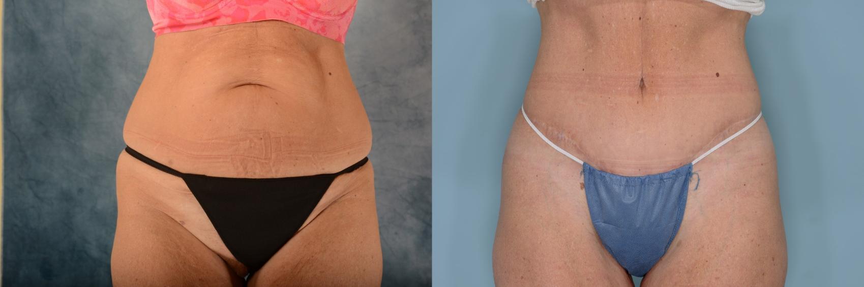 Before & After Tummy Tuck (Abdominoplasty) Case 657 Front View in Tallahassee, FL