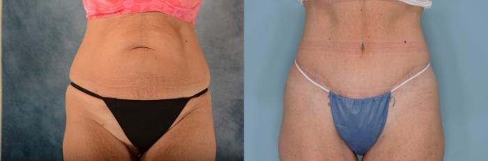 Before & After Tummy Tuck (Abdominoplasty) Case 657 Front View in Tallahassee, FL