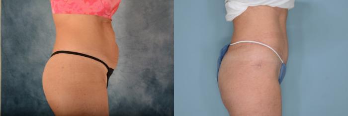Before & After Tummy Tuck (Abdominoplasty) Case 657 Right Side View in Tallahassee, FL
