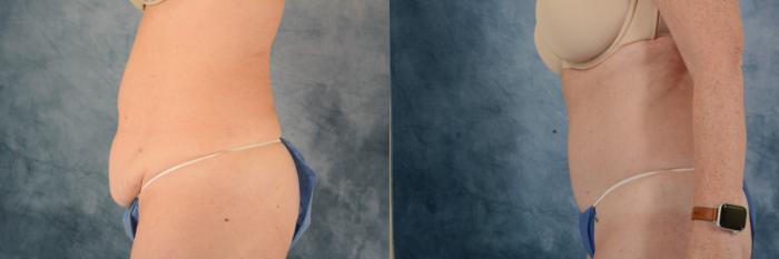 Before & After Tummy Tuck (Abdominoplasty) Case 663 Left Side View in Tallahassee, FL