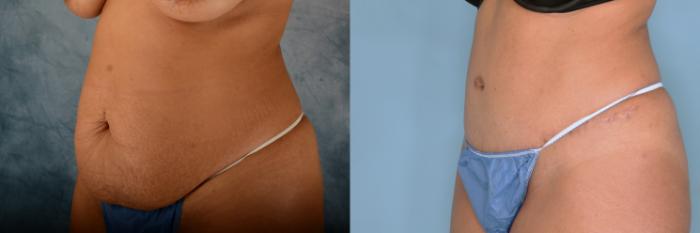 Before & After Tummy Tuck (Abdominoplasty) Case 667 Left Oblique View in Tallahassee, FL