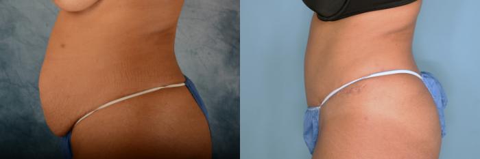 Before & After Tummy Tuck (Abdominoplasty) Case 667 Left Side View in Tallahassee, FL