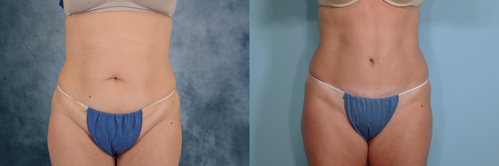 Before & After Tummy Tuck (Abdominoplasty) Case 675 Front View in Tallahassee, FL