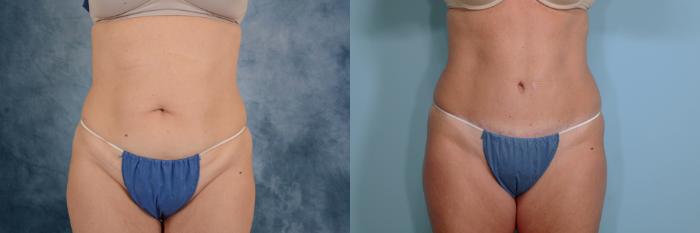 Before & After Tummy Tuck (Abdominoplasty) Case 675 Front View in Tallahassee, FL