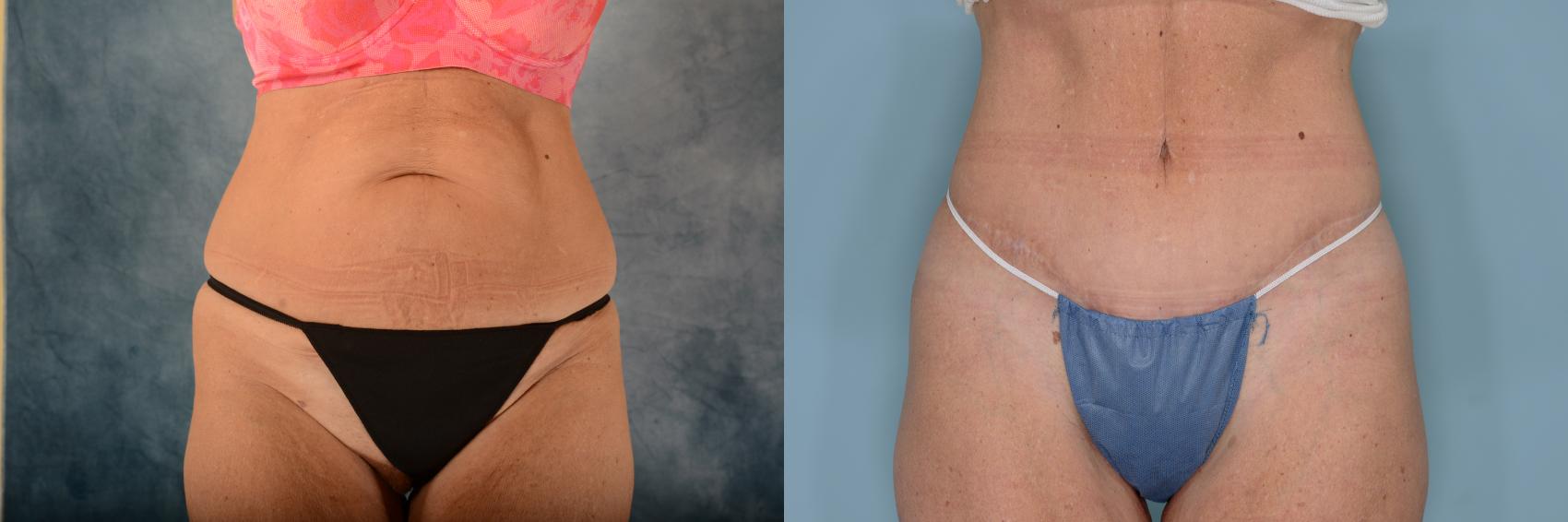 Before & After Tummy Tuck (Abdominoplasty) Case 701 Front View in Tallahassee, FL