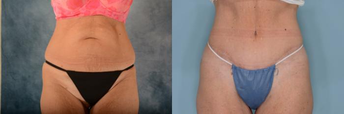 Before & After Tummy Tuck (Abdominoplasty) Case 701 Front View in Tallahassee, FL