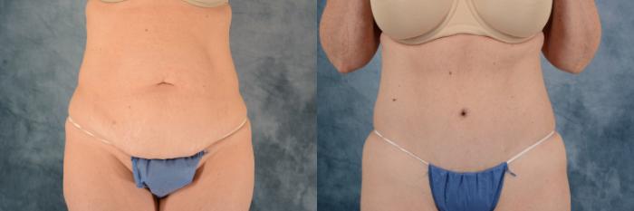 Before & After Tummy Tuck (Abdominoplasty) Case 714 Front View in Tallahassee, FL
