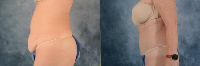 Before & After Tummy Tuck (Abdominoplasty) Case 714 Left Side View in Tallahassee, FL