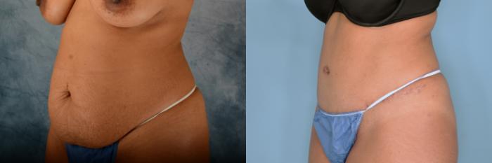 Before & After Tummy Tuck (Abdominoplasty) Case 715 Left Oblique View in Tallahassee, FL