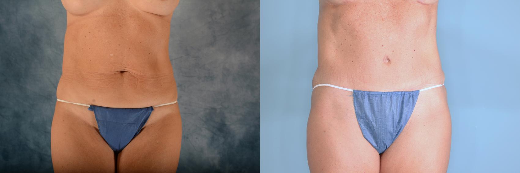 Before & After Tummy Tuck (Abdominoplasty) Case 727 Front View in Tallahassee, FL