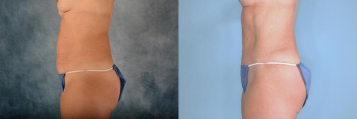 Before & After Tummy Tuck (Abdominoplasty) Case 727 Left Side View in Tallahassee, FL